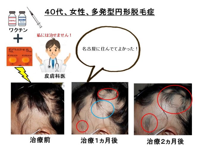 円形脱毛症　病院